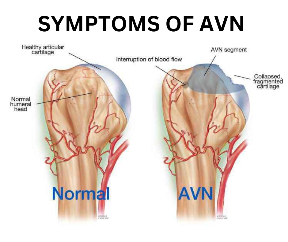 hip avascular necrosis symptoms