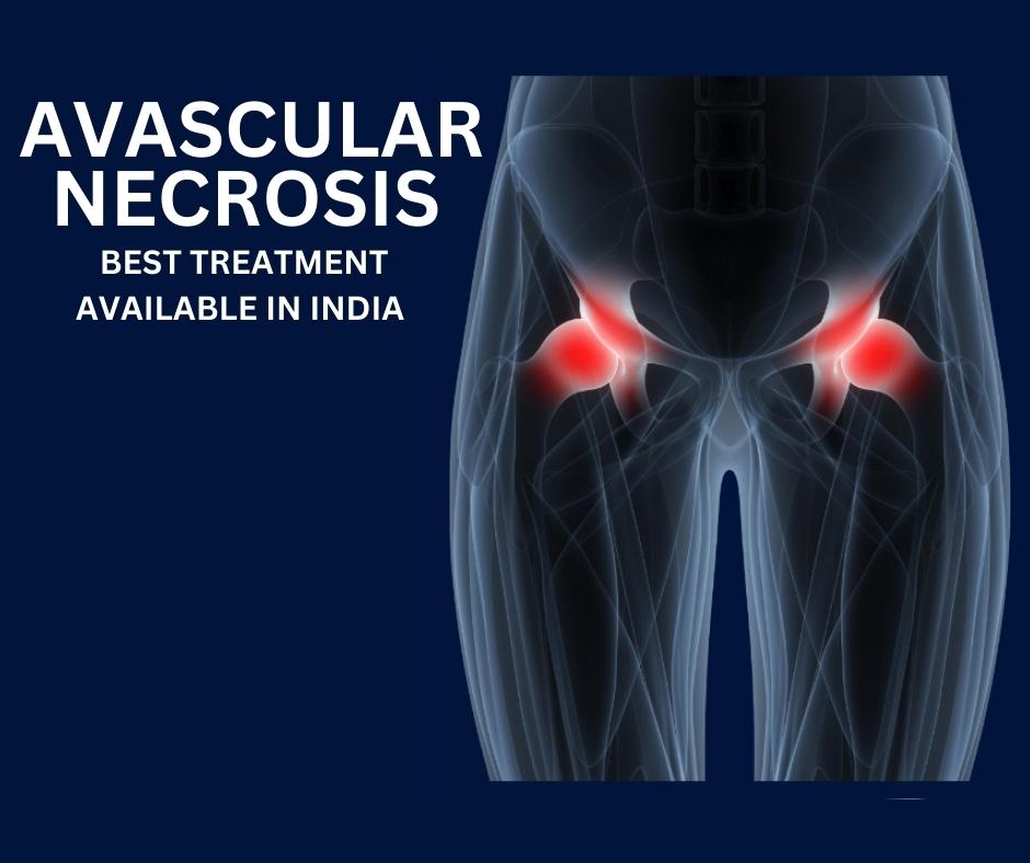 Best Avascular Necrosis Stage Treatment in India - Chaitanya Stem Cell ...