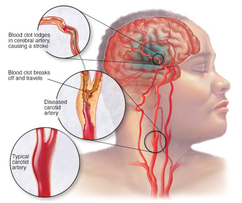 brain stroke treatment in india