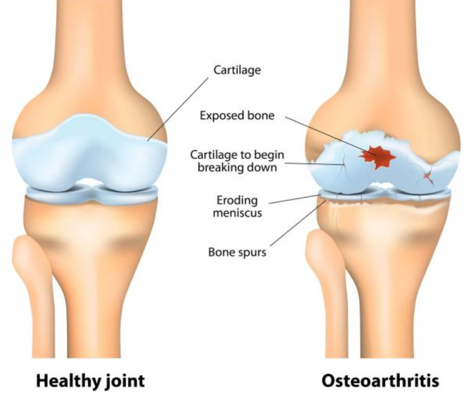 osteoarthritis treatment