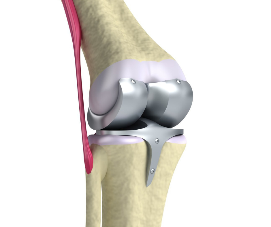 fast track knee replacement