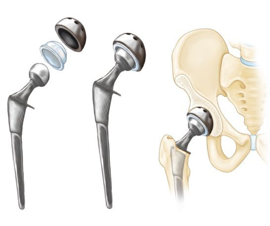Total Hip Replacement  Central Coast Orthopedic Medical Group