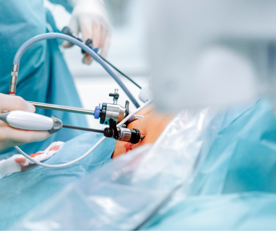 best laparoscopic sleeve gastrectomy surgery in india