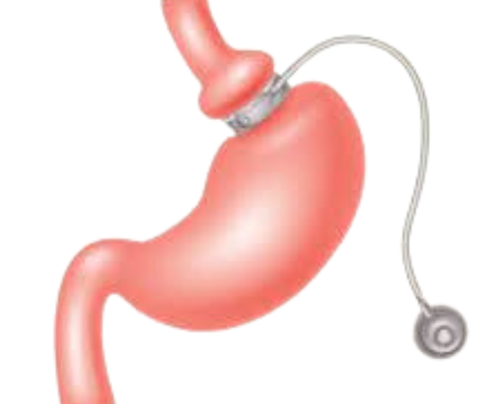 gastric banding surgery