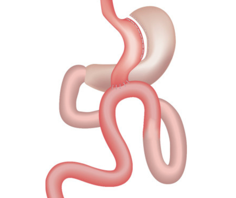 mini gastric bypass