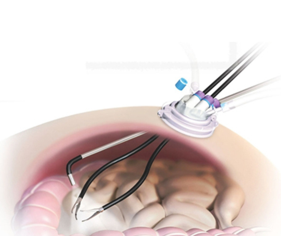 single incision laparoscopic surgery